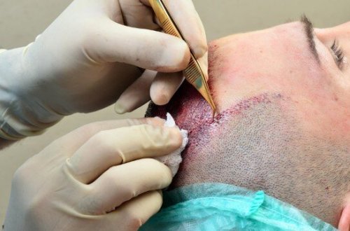 Saç əkimi əməliyyatında həyatından oldu - FOTO