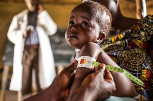 Konqoda 165 uşaq naməlum xəstəlikdən ölüb