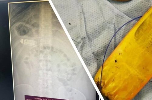 Həkimlər ŞOKDA: Mədəsindən TELEFON ÇIXDI - FOTO