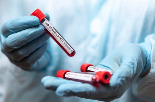 Azərbaycanda bir gündə 30 nəfər koronavirusdan öldü - FOTO