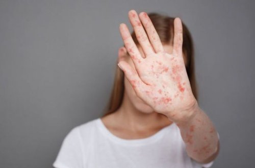 ВОЗ предупредила об угрозе вспышек кори из-за сбоев в плановой вакцинации в 2020 году