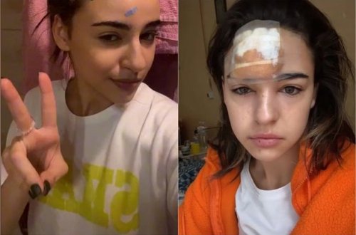 Alnındakı sızanağı sıxan qızın başında şiş yarandı - FOTO/VİDEO