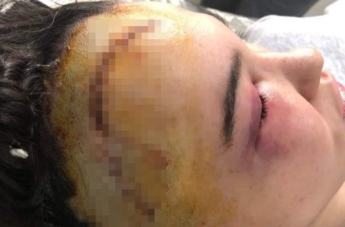 Küləkli havada “Tarqovı”da başına daş düşdü, müalicəsini edən yoxdur - Foto