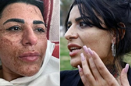 Lazer epilyasiyası zamanı qadının üzünü yandırıb bu hala saldılar – FOTO