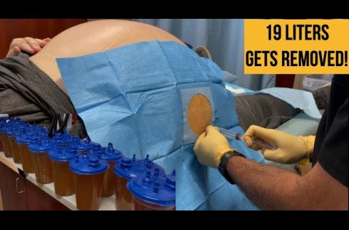 Xəstənin şişmiş qarnından görün nə çıxdı - VİDEO