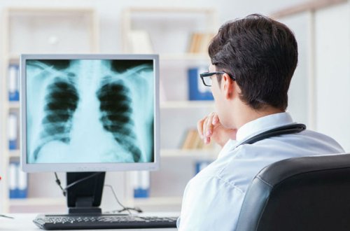 Ağciyər xərçənginin qeyri-adi əlaməti açıqlanıb - FOTO