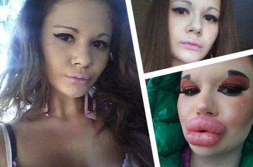 Dodaqlarını 26 dəfə böyüdüb, özünü bu günə saldı - FOTO