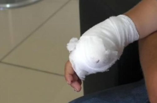 Mingəçevirdə 41 yaşlı kişi barmağını kəsib atdı