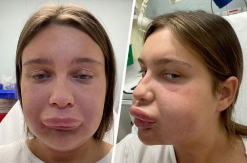 Женщина стала похожа на Гомера Симпсона после неудачной инъекции в губы - ВИДЕО