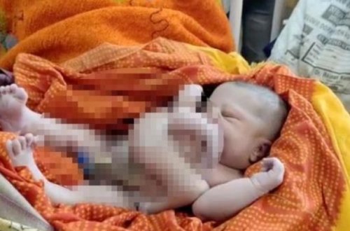 Dörd qolu və dörd ayağı olan körpə dünyaya gəldi - FOTO