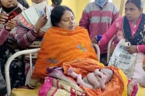 Hindistanda dörd əli və dörd ayağı olan uşaq doğulub - FOTO