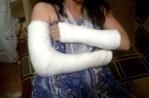 В Баку мужчина сломал руки своей невесте