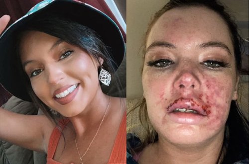 Daha gözəl görünmək istəyərkən dodağını itirmək təhlükəsi ilə üzləşdi - FOTO