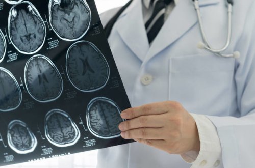 Врач назвала симптомы немого инсульта