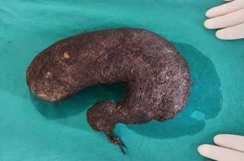 Mədəsindən 2 kiloya yaxın tük çıxdı - FOTO