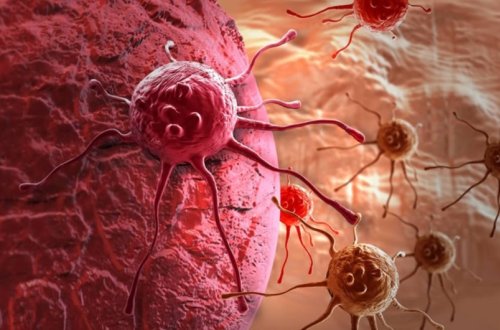 Xərçəng xəstəliyinin nadir formasının əlamətləri açıqlanıb