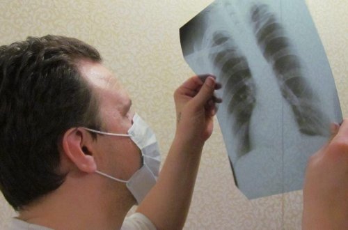 Azərbaycanda vərəmin yayılması və bu xəstəlikdən ölüm halları azalıb