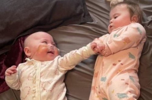 Həyatda qalan ən kiçik körpə: 450 qram çəki ilə doğulub - FOTO