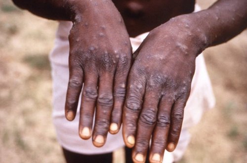 Nazirlik: “Hazırda Azərbaycanda “Meymun çiçəyi” virusu yoxdur”