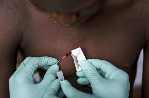 ÜST “Meymun çiçəyi” virusunun kəskin yayılması ilə bağlı təcili görüş çağırıb