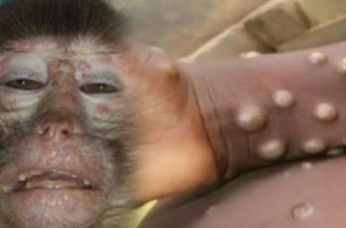 ÜST: Avropanın 8 ölkəsində meymun çiçəyinə yoluxma qeydə alınıb