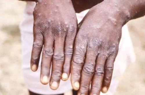 Böyük Britaniyada meymun çiçəyinə yoluxanların sayı 56-ya çatıb