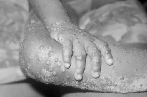 TƏBİB: “Meymunçiçəyi virusu səbəbindən bəzi hallarda ölüm halları müşahidə oluna bilər”