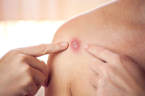 Britaniyada meymunçiçəyinə yoluxma sayı 106-ya yüksəlib