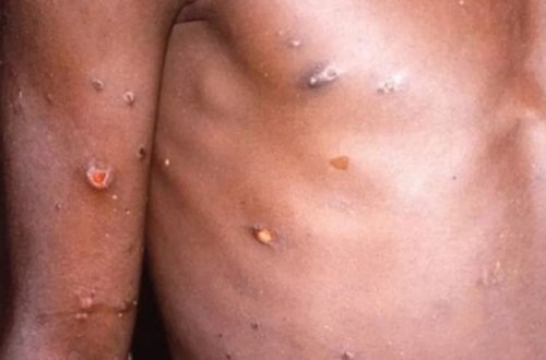 Bu ölkədə meymunçiçəyi xəstəliyindən ilk ölüm baş verdi