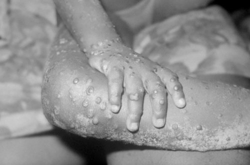 Nigeriyada meymunçiçəyi xəstəliyindən ilk ölüm faktı qeydə alınıb