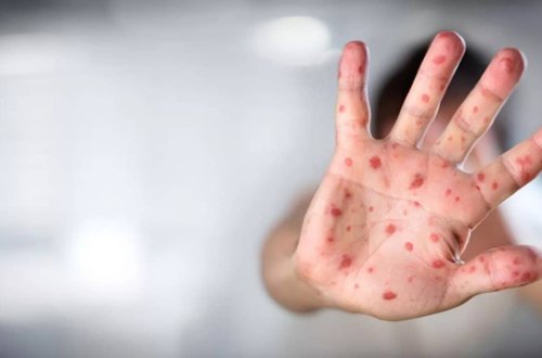 İngiltərədə meymunçiçəyi yoluxmasının sayı 179-a yüksəlib