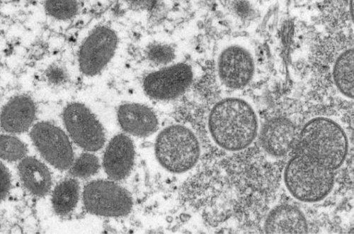 İtaliyada meymunçiçəyinə 20 yoluxma aşkar edilib