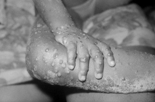 Britaniyada meymunçiçəyinə 200-dən çox yoluxma qeydə alınıb