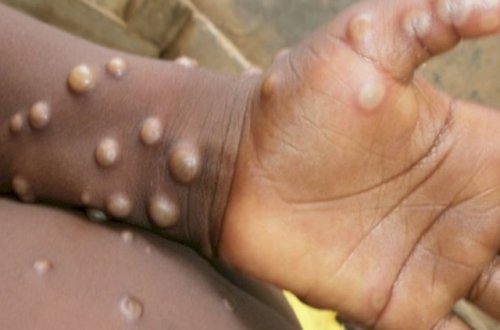 Portuqaliyada 150-dən çox insanda meymunçiçəyi aşkarlanıb