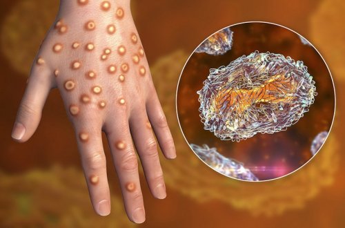 Almaniyada meymunçiçəyinə 113 yoluxma qeydə alınıb