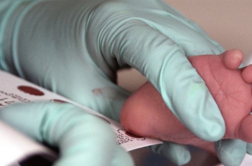 İndiyədək Azərbaycanda topuq testinə 800-ə yaxın uşaq cəlb olunub