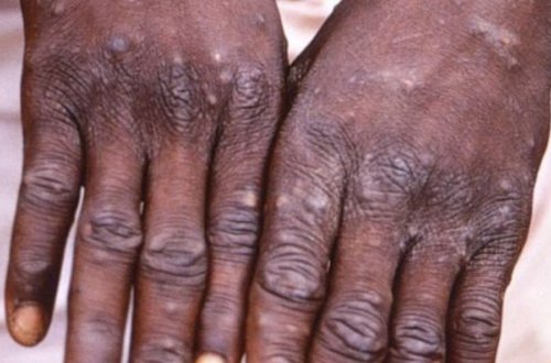 Bir həftə ərzində qeyri-endemik ölkələrdə meymunçiçəyinə 505 yoluxma halı qeydə alınıb