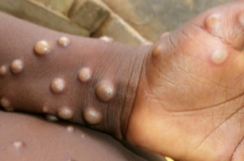 Daha bir ölkədə meymunçiçəyinə yoluxma faktı aşkarlanıb