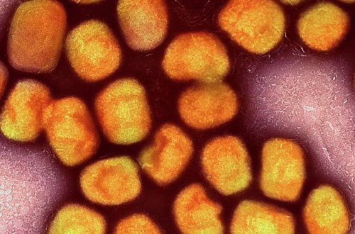 Venesuelada meymunçiçəyi virusuna ilk yoluxma halı qeydə alınıb