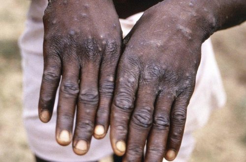 Britaniyada meymunçiçəyinə yoluxanların sayı kəskin artıb