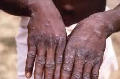 Yaşı 40-dan yuxarı olan şəxslər üçün meymunçiçəyinin qorxusu yoxdur - RƏSMİ