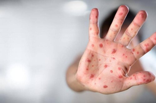 Livanda meymunçiçəyinə ilk yoluxma halı aşkarlanıb