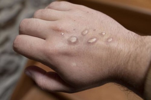 Britaniyada meymunçiçəyinə yoluxma sayı min nəfəri ötüb