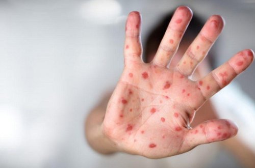 Meymunçiçəyi virusunun diaqnostika və müalicəsi üzrə klinik protokol hazırlanıb