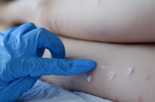 Meymunçiçəyinin sağalma müddəti və müalicədə istifadə olunan dərmanlar açıqlanıb