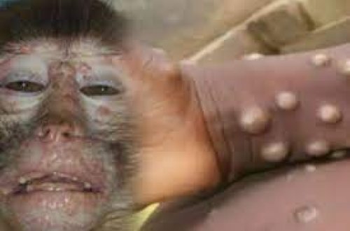 Niderlandda ilk dəfə uşaqda meymunçiçəyi aşkarlanıb