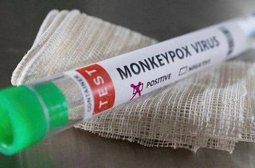 ÜST-dən meymunçiçəyi bəyanatı: 3 nəfər ÖLÜB