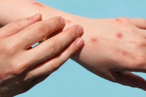 Rusiyada meymunçiçəyini aşkar edən test hazırlanıb