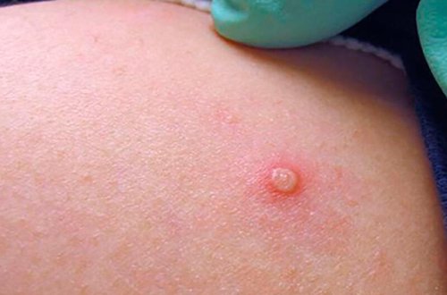 Azərbaycanda meymunçiçəyinə yoluxma qeydə alınmayıb - RƏSMİ