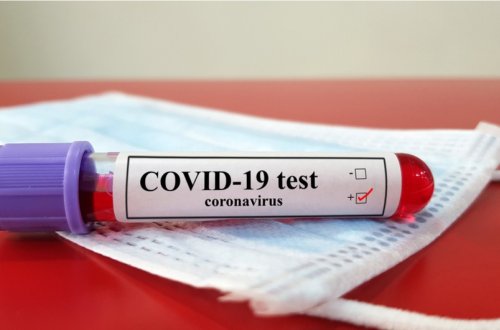 Azərbaycanda daha 305 nəfər COVID-19-a yoluxub, 2 nəfər ölüb